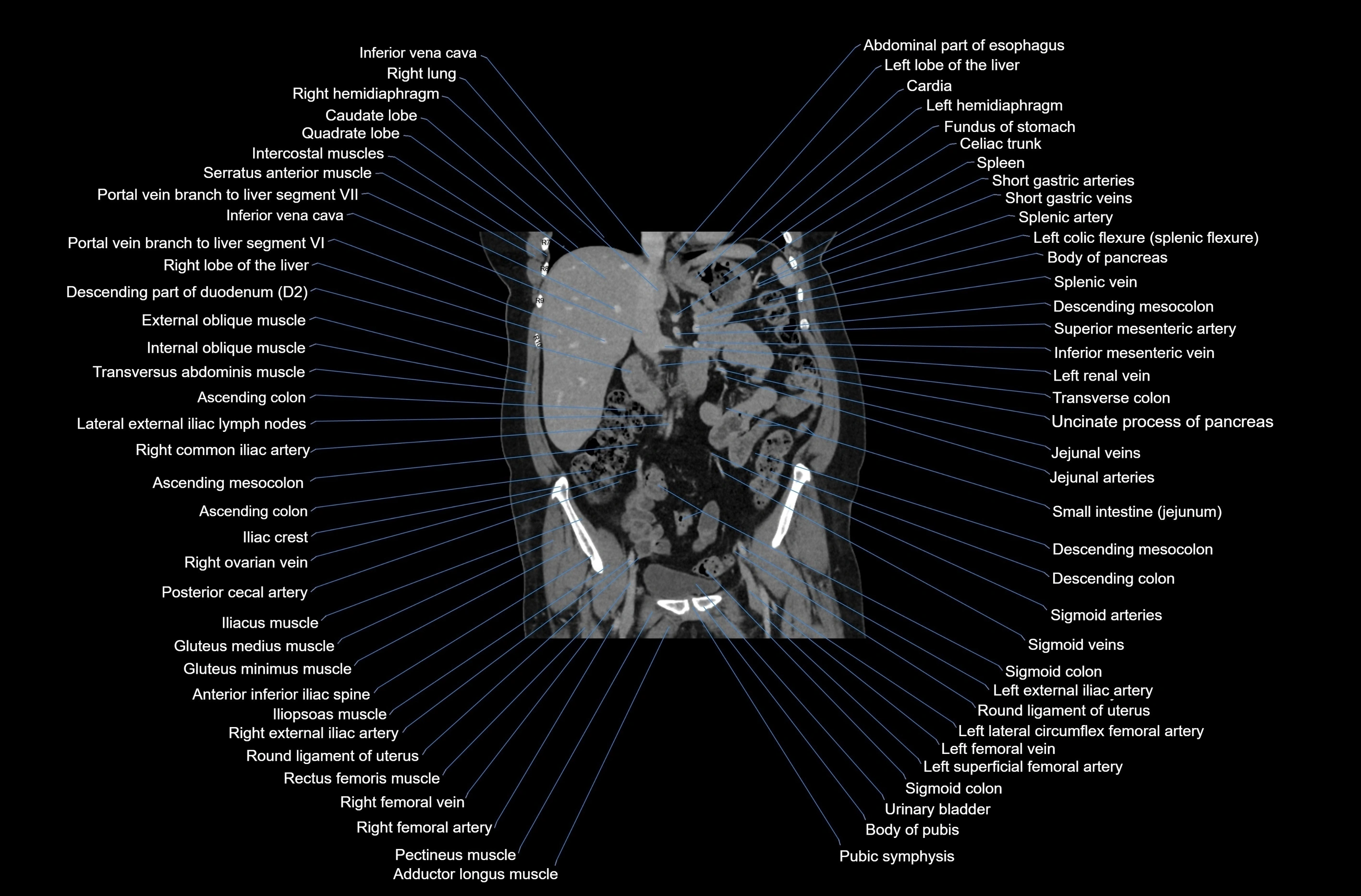 CT abdomen coronal cross sectional anatomy labelled radiology image-00042.webp